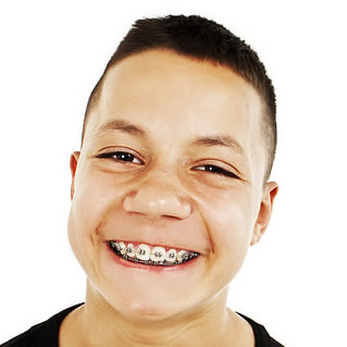 life with braces